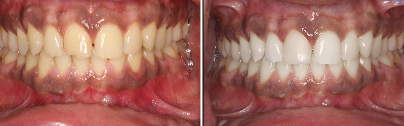 Mouth Rehabilitation