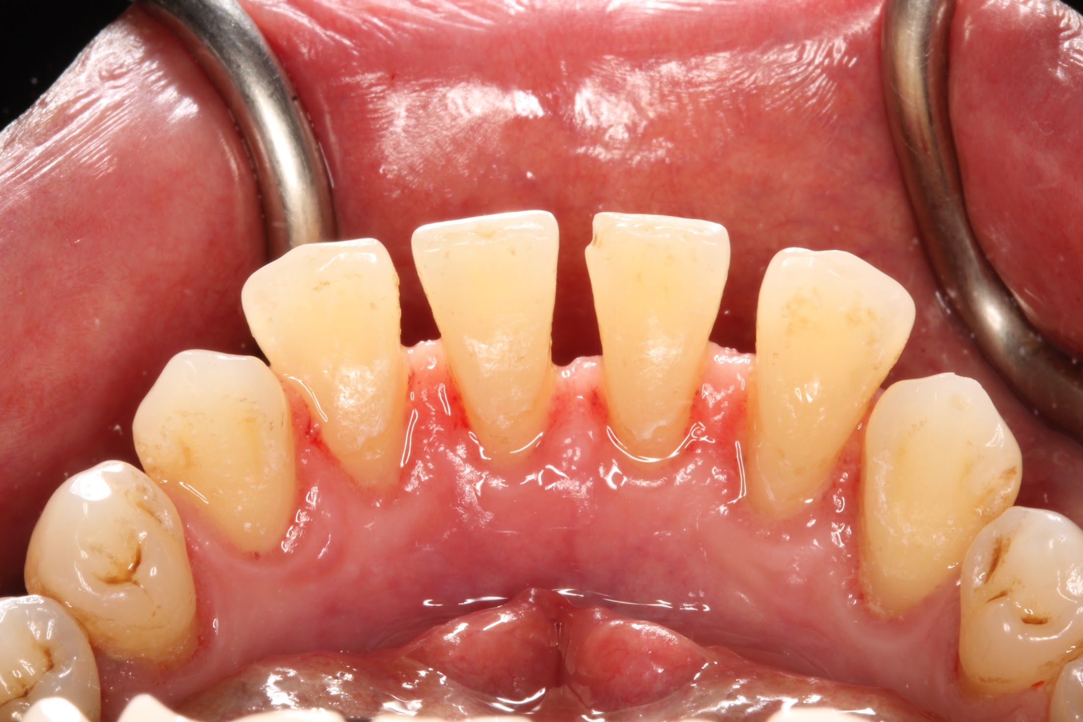 periodontal cleanings