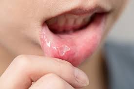 Oral Ulcers
