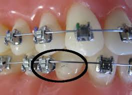 Breakage of orthodontic brackets