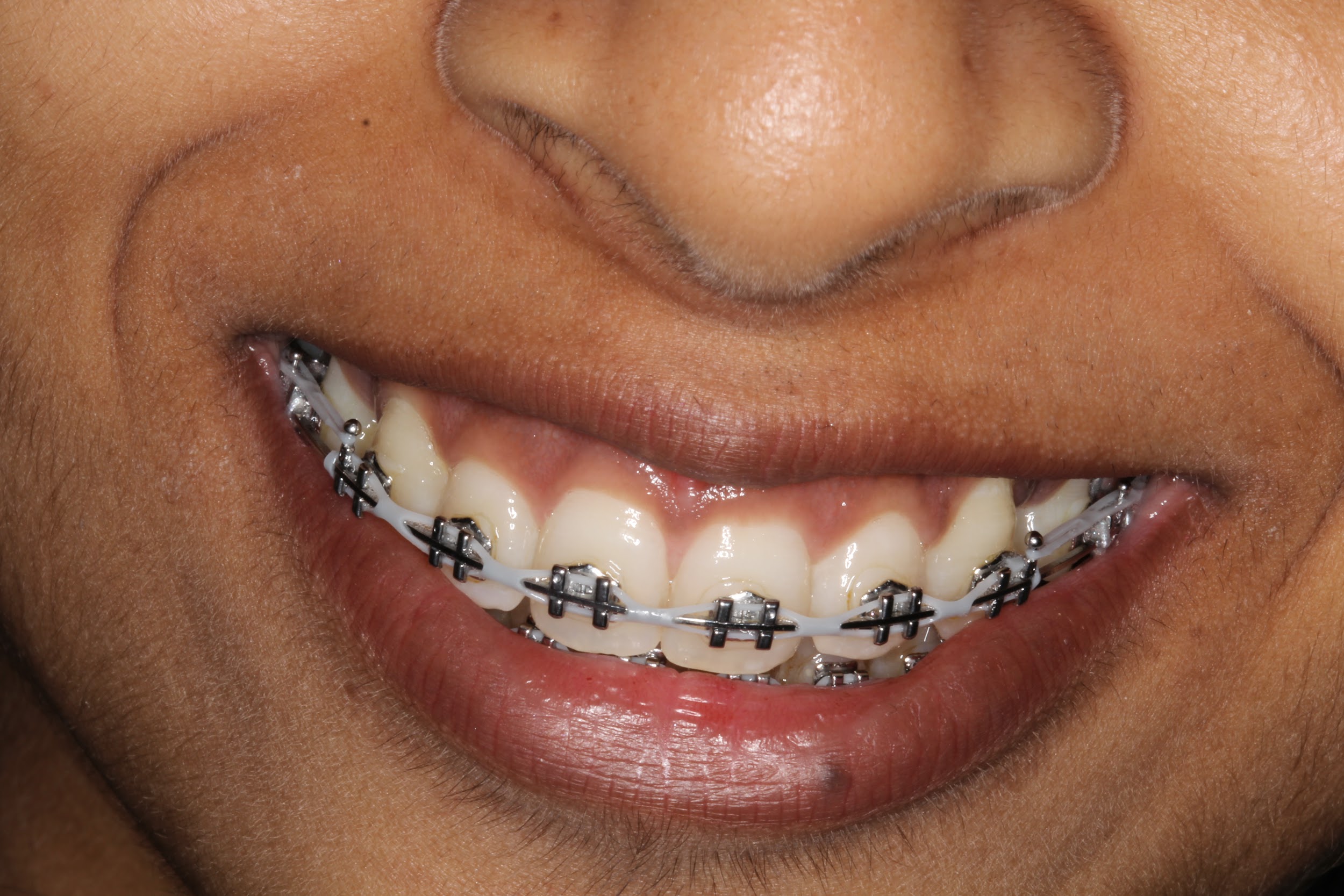 Braces