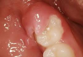 pericoronitis gel