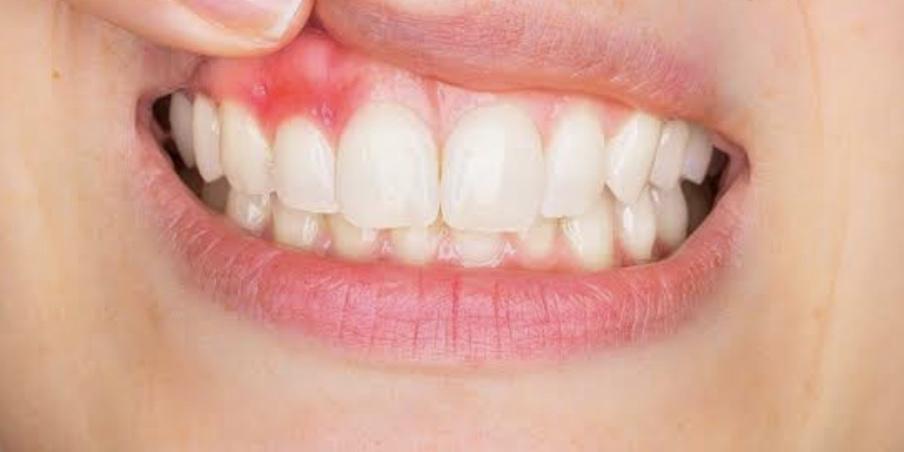 Damaged gums