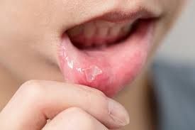 Mouth Ulcer