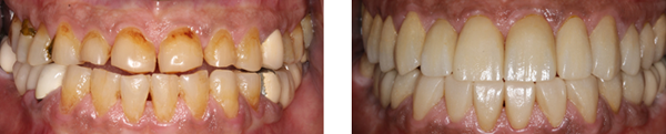 Full Mouth Rehabilitation