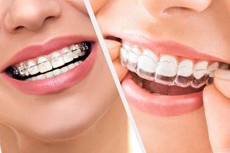 braces types by best orthodontist