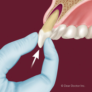 Removing tooth from jaw